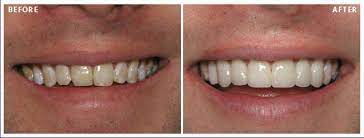 It is characterized by yellowish color of the teeth, presence of white spots, and discolorations like brown spots. What Is Fluorosis How To Deal It St Lawrence Dentistry