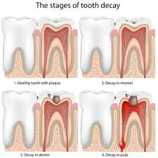what is a tooth abscess