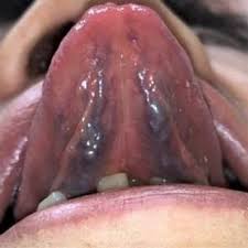 tongue manifestations a and e non