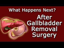 you ve had gallbladder removal surgery