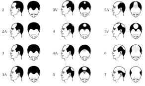 Diagnosing Mens Hair Loss Norwood Scale Chart