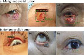 malignant eyelid tumors