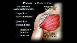 pectis muscle tendon tear