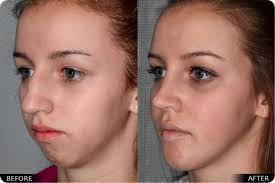 jaw surgery guilford ct orthognathic