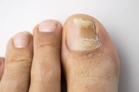 never ignore toenail fungus advanced