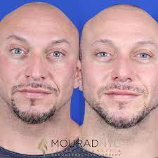 Septoplasty is the only way to correct a deviated septum, which can make breathing through the nose difficult and force breathing through the mouth. Male Deviated Septum Rhinoplasty Before And After Head And Neck Surgeon