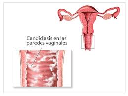 candidiasis y cisis en el embarazo