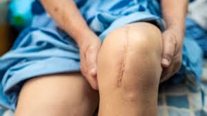 scar tissue after knee replacement surgery