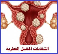 الالتهابات المهبلية بالصور