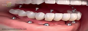 cost for full dental implants
