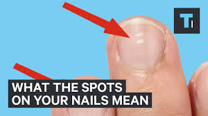 white marks on nails mean about health