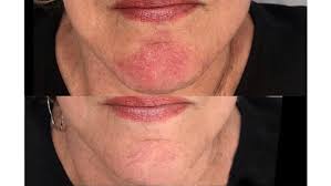 laser treatment for rosacea types