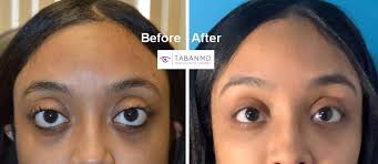 what is eye shape change dr taban md