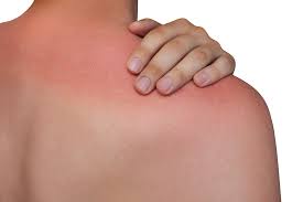 sunburn and sun poisoning