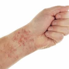Dermal tissue atrophy resulting from sun exposure and aging is the most common cause. Henoch Schonlein Purpura Familydoctor Org