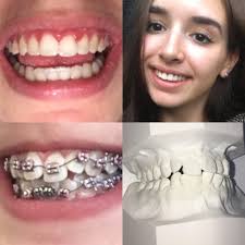 The stimulus to seek orthodontic treatment can come from you or your dentist. 15 Drastic Transformations Of People Before And After Braces