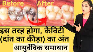 how to cure tooth cavity at home in