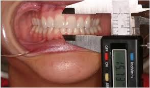 Get latest treatement for fixing overbite without surgery or braces. Not All Tmj Patients Are Created Equal A Case Study Dentistry Today