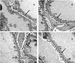 Thin Basement Membrane Nephropathy