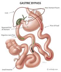 gastric byp weight loss surgery