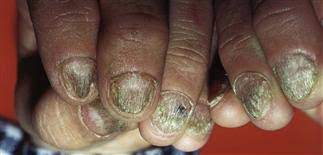 trachyonychia twenty nail dystrophy