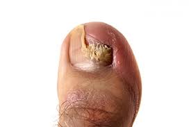 types of toenail fungus