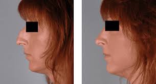 rhinoplasty recovery guideline spring