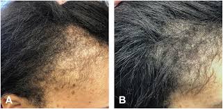 minoxidil before and after photos