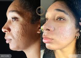 acne scars and pih in african black skin