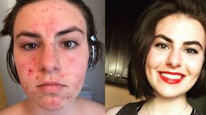 woman got very real about her acne journey