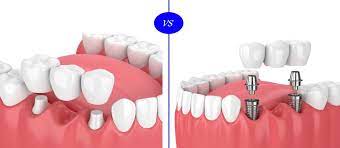 fixed bridges vs dental implants