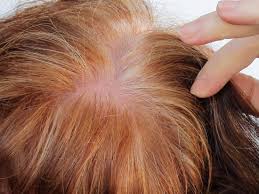 How hair colour varies according to body site. Prp For Hair Loss Does It Work And Is It Safe
