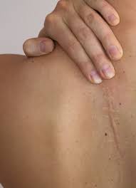 mole removal scars will mole removal