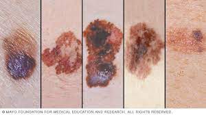 You should always consult a doctor if you are in any doubt and build up an if you are concerned about a mole or mark on your skin and have not had it examined by a doctor, the only safe thing to do is to make a doctor's. Slide Show Melanoma Pictures To Help Identify Skin Cancer Mayo Clinic
