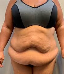 Fajas compression swelling post op care after bbl tummy tuck. Patient 4058 Tummy Tuck Before And After Photos Calhoun Ga Plastic Surgery Gallery Chattanooga Tn Southern Surgical Arts