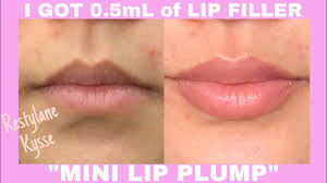 0 5ml restylane kysse mini lip filler