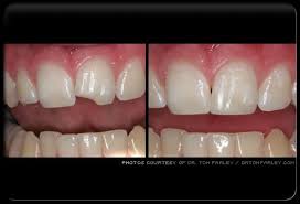 Why is teeth bonding done? Dental Bonding Picture Image On Medicinenet Com
