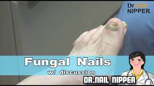 fungal nails with a dr nail nipper