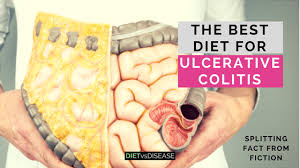 The Best Diet For Ulcerative Colitis Splitting Fact From