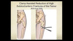 proximal femur fractures how to
