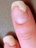 onycholysis or nail lifting treatment