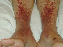 Purpura has a wide array of possible causes that range from a temporary drug side effect to a sign of a serious underlying medical condition. Red Rashes On The Lower Legs Page 2 Of 3 Clinical Advisor