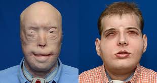 Maybe you would like to learn more about one of these? Amazing Face Transplants Graphic Images Cbs News