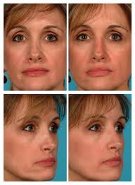 Review the surgeons before and after photographs to ensure expertise. Liquid Rhinoplasty Before And After Pictures
