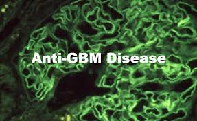 Anti Gbm Disease