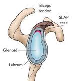 Image result for icd 9 code for superior labral tear
