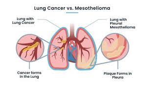 Multimodal treatment typically leads to the most favorable outcomes. Pleural Mesothelioma Vs Lung Cancer Diagnosis Treatment