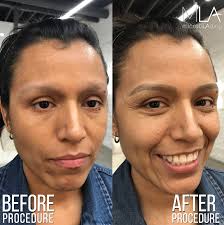 video eyebrow microblading for cancer