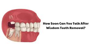 talk after wisdom teeth removal