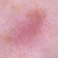 Our overview of melanoma pictures includes pictures of moles and other skin lesions, that you can use as a first comparison to any moles you might feel uncomfortable with. Amelanotic Melanoma It Doesn T Look Like Other Melanomas The Skin Cancer Foundation